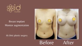 Before and after breast augmentation results at ID Clinic Bangkok with Mentor implants