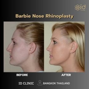 Before and after Barbie nose rhinoplasty results at ID Clinic Bangkok, refined nose profile