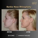 Before and after Barbie nose rhinoplasty results at ID Clinic Bangkok, refined nose profile