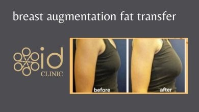 Before and after breast augmentation with fat transfer at ID Clinic Bangkok, visible volume result