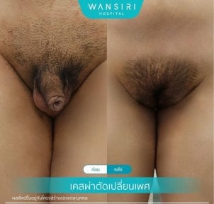 Результаты до и после операции по смене пола в Wansiri Hospital, видимая трансформация