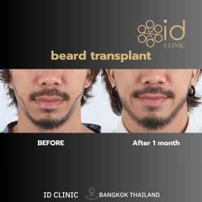 Before and after beard transplant results at ID Clinic Bangkok, fuller beard after 1 month