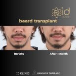Before and after beard transplant results at ID Clinic Bangkok, fuller beard after 1 month