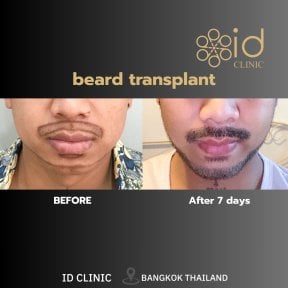 Before and after beard transplant results at ID Clinic Bangkok, fuller beard after 7 days