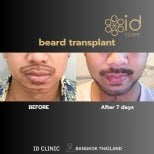 Before and after beard transplant results at ID Clinic Bangkok, fuller beard after 7 days