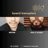 Before and after beard transplant results at ID Clinic Bangkok, fuller beard after 3 months