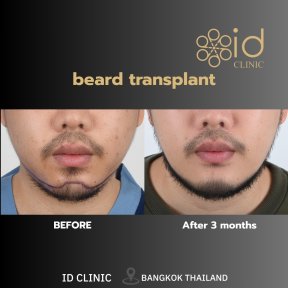 Before and after beard transplant results at ID Clinic Bangkok, fuller beard after 3 months