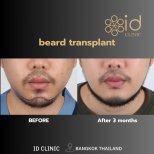 Before and after beard transplant results at ID Clinic Bangkok, fuller beard after 3 months