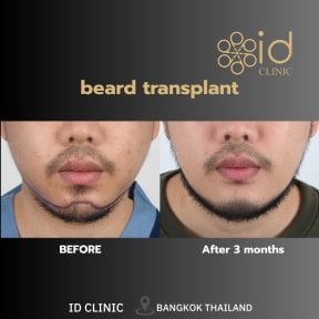 Before and after beard transplant results at ID Clinic Bangkok, fuller beard after 3 months