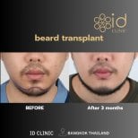 Before and after beard transplant results at ID Clinic Bangkok, fuller beard after 3 months