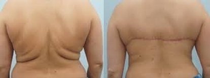 Résultats avant et après lifting du dos à ID Clinic Bangkok, contour amélioré après retrait de peau