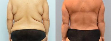 Avant et après Brazilian Butt Lift à ID Clinic Bangkok, résultat visible du remodelage corporel