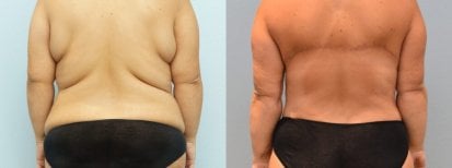 Avant et après Brazilian Butt Lift à ID Clinic Bangkok, résultat visible du remodelage corporel
