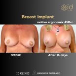 Before and after breast augmentation with Motiva 450cc implants at ID Clinic Bangkok results