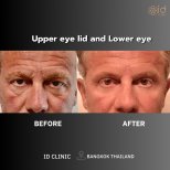Before and after lower eyelid blepharoplasty results at ID Clinic Bangkok, rejuvenated eyes