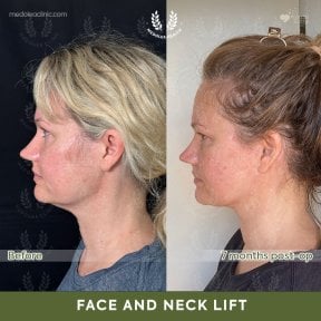 before-after photo deep-plane-facelift