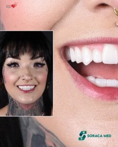 before-after photo gollivudskaya-ulybka