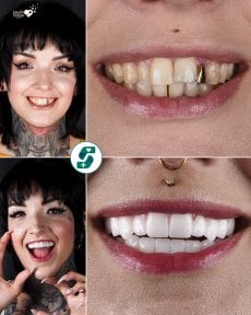 before-after photo gollivudskaya-ulybka