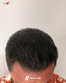 before-after photo hair-transplant