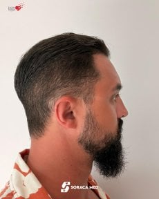 before-after photo hair-transplant