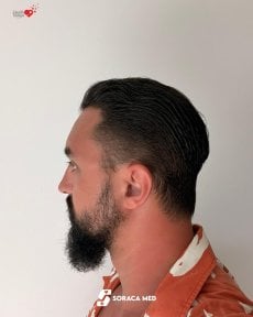before-after photo hair-transplant
