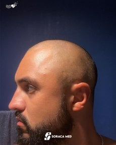 before-after photo hair-transplant