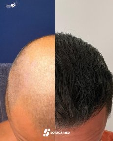 before-after photo hair-transplant
