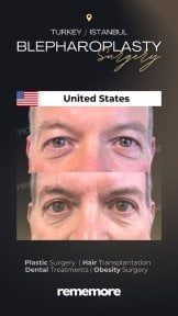 before-after photo blepharoplasty-eyelid