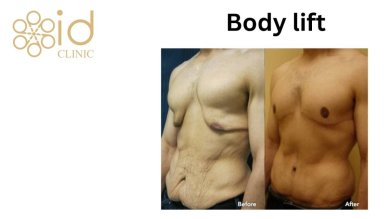before-after photo breast-reduction