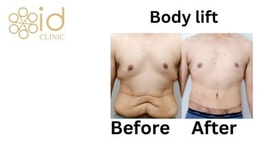 before-after photo breast-reduction