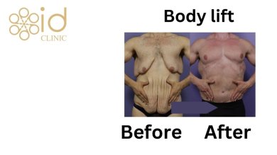 before-after photo breast-reduction