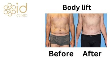 before-after photo breast-reduction