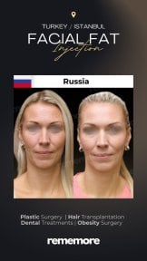 before-after photo podtazka-brovej