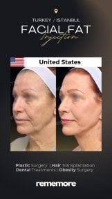 before-after photo podtazka-brovej