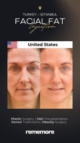 before-after photo podtazka-brovej
