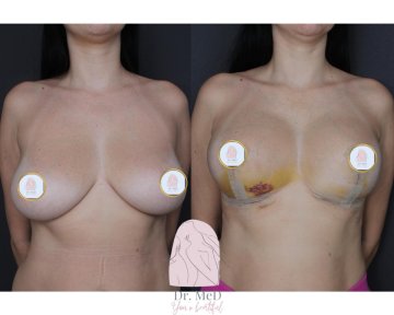 before-after photo liposuction