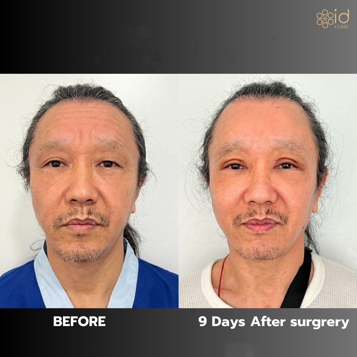 Resultados de lifting de cejas antes y después en ID Clinic Bangkok, mejora visible en frente y ojos