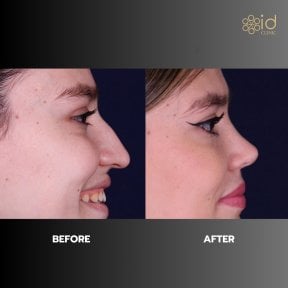 before-after photo rhinoplasty-nose-job
