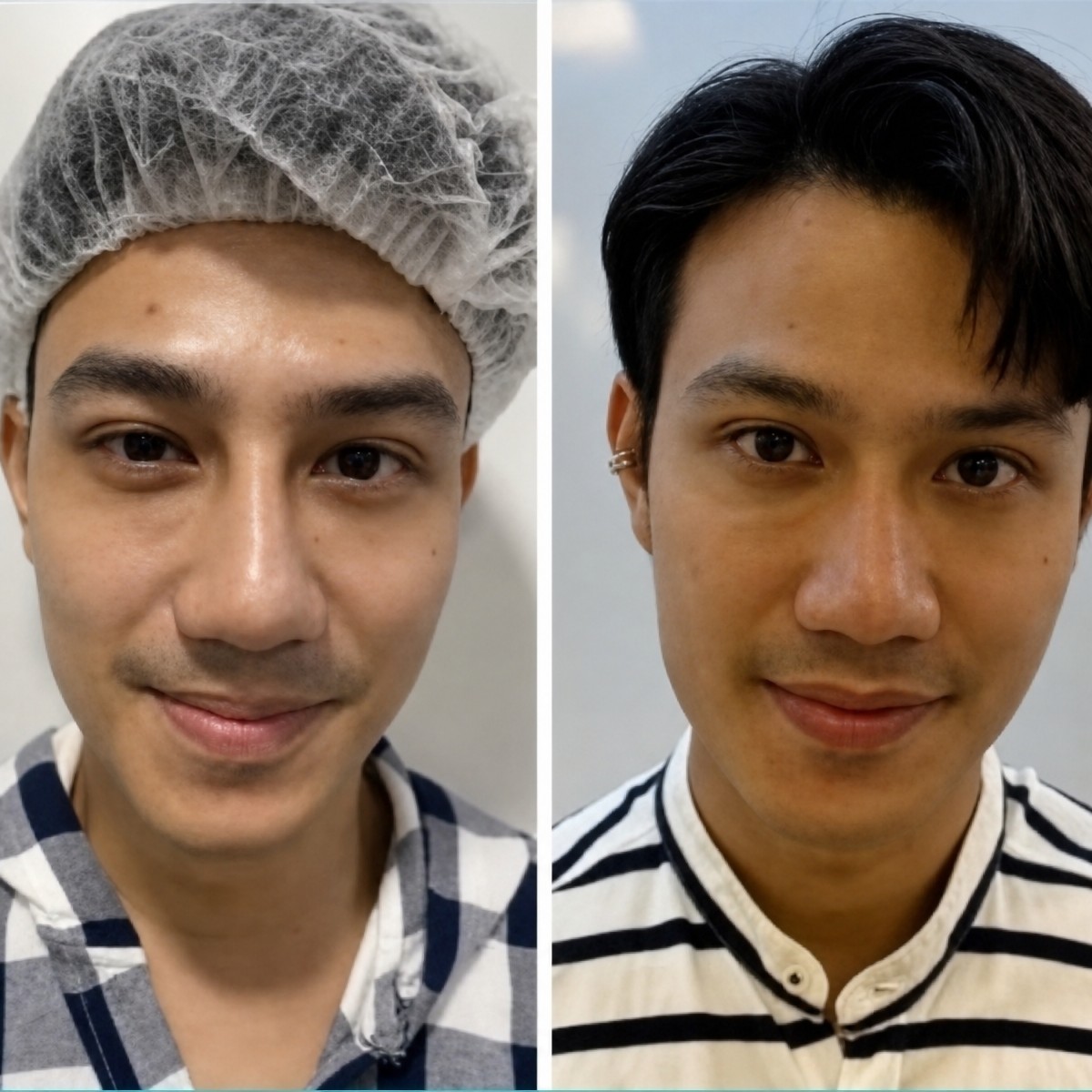 نتيجة قبل وبعد تجميل الأنف الآسيوي في ID Clinic Bangkok، إعادة تشكيل طبيعية للأنف