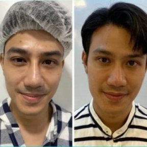 before-after photo asian-rhinoplasty