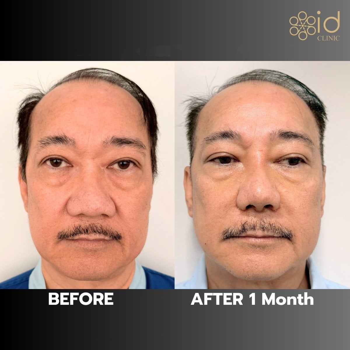 نتيجة تجميل الأنف الآسيوي قبل وبعد شهر في ID Clinic Bangkok، تحسين شكل الأنف