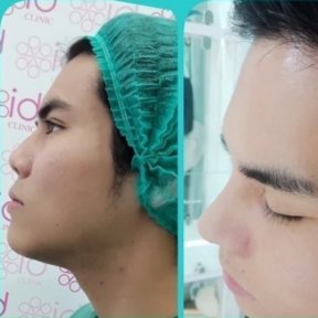 before-after photo asian-rhinoplasty