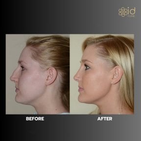 before-after photo rhinoplasty-nose-job