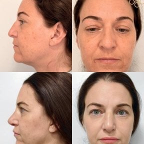 before-after photo rhinoplasty-nose-job