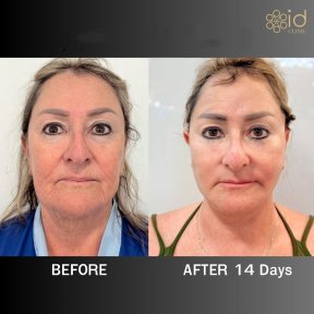 before-after photo brow-lift