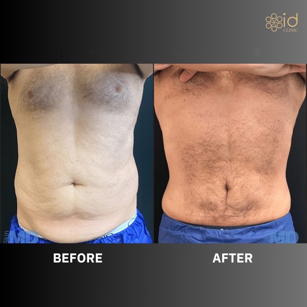 Resultados de BodyTite antes y después en ID Clinic Bangkok, abdomen mejorado