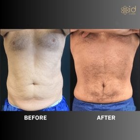 before-after photo bodytite-body-contouring