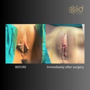 before-after photo labiaplasty