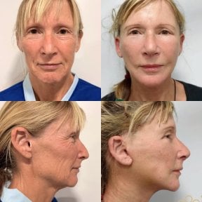 before-after photo deep-plane-facelift