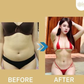before-after photo abdominal-liposuction